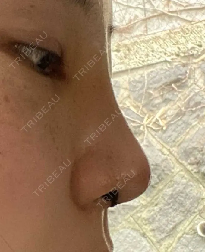 鼻尖形成（切開） / 鼻中隔延長（切開） / 軟骨移植 湘南美容クリニック 藤沢院 DAY 14 メイン用