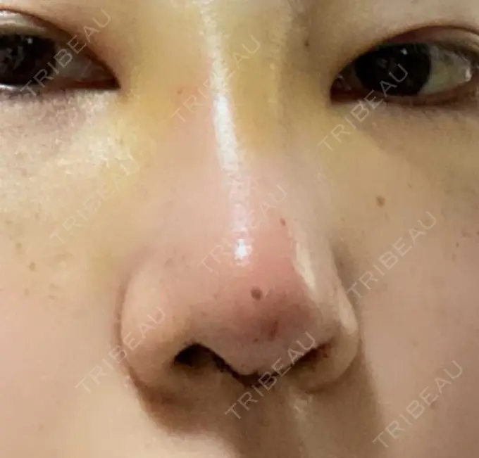 鼻尖形成（切開） / 鼻中隔延長（切開） / 軟骨移植 湘南美容クリニック 藤沢院 DAY 14 メイン用