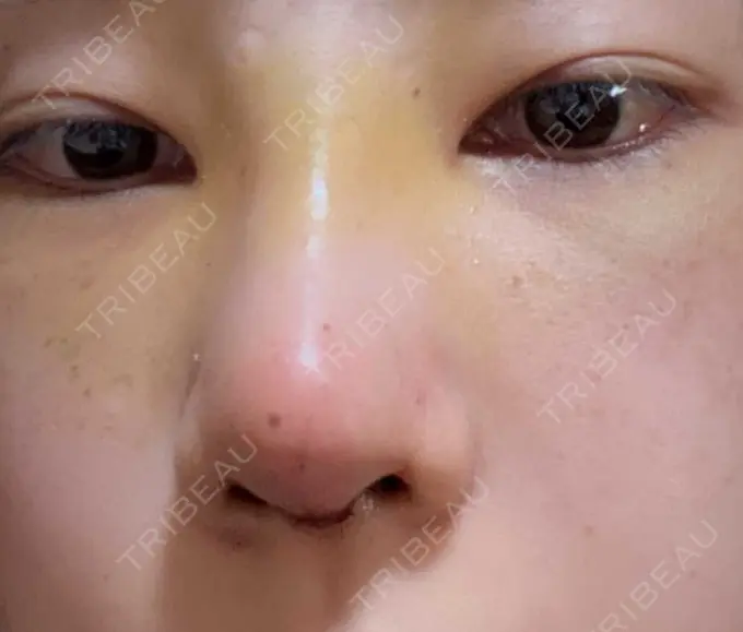 鼻尖形成（切開） / 鼻中隔延長（切開） / 軟骨移植 湘南美容クリニック 藤沢院 DAY 14 メイン用