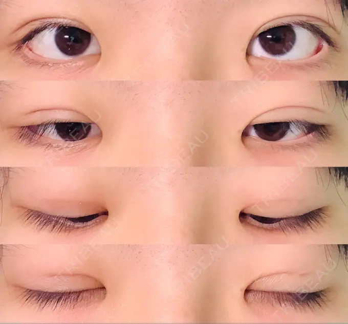 二重埋没 水の森美容クリニック 東京新宿院 DAY 8 メイン用