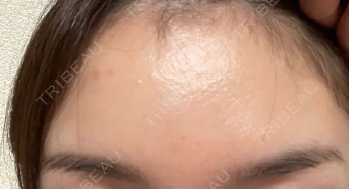 ボトックス（額） TCB東京中央美容外科 静岡院 DAY 20 メイン用