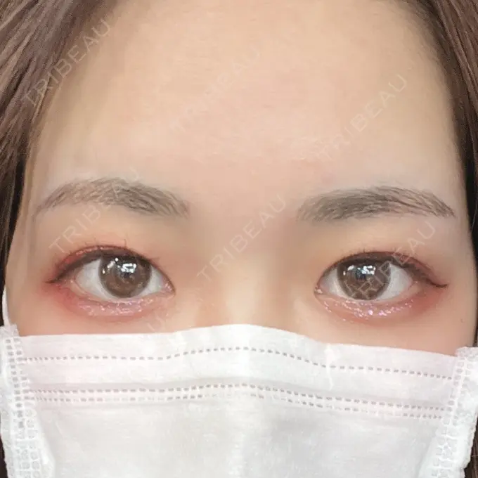 アートメイク（眉） 表参道ウィズ・クリニック AFTER メイン用