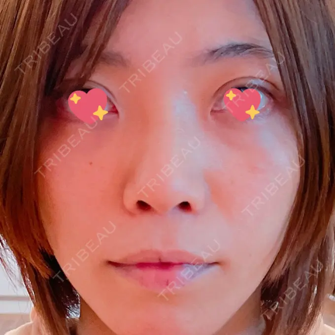 人中短縮 / その他（口元） eクリニック 金沢本院 DAY 314 メイン用