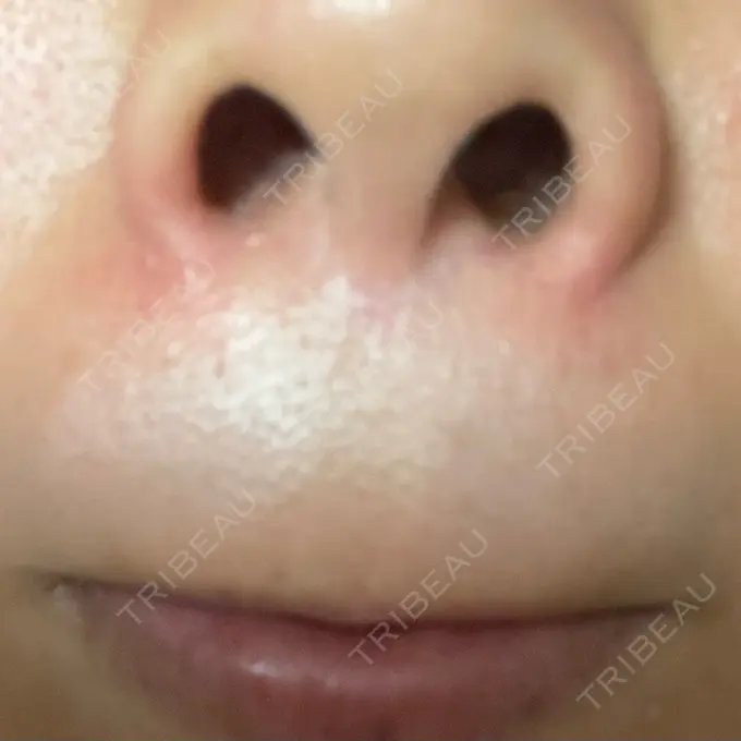 人中短縮 / その他（口元） eクリニック 金沢本院 DAY 314 メイン用