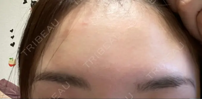 ボトックス（額） TCB東京中央美容外科 静岡院 DAY 23 メイン用