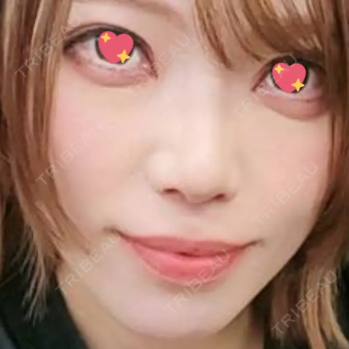 人中短縮 / その他（口元） eクリニック 金沢本院 DAY 314 メイン用