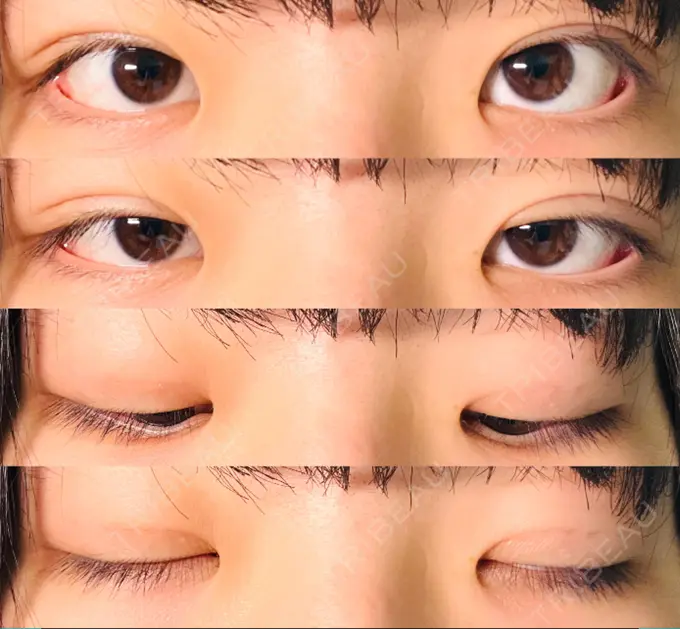 二重埋没 水の森美容クリニック 東京新宿院 DAY 9 メイン用