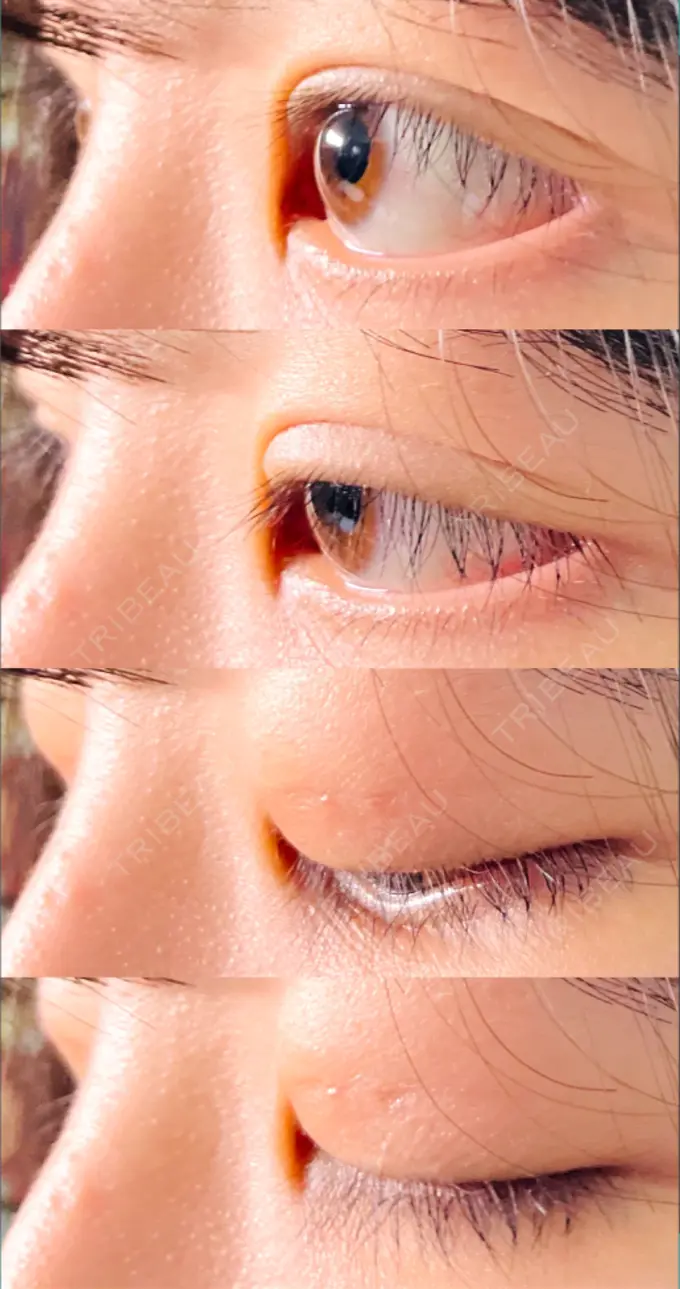 二重埋没 水の森美容クリニック 東京新宿院 DAY 9 メイン用