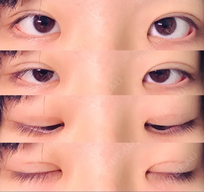 二重埋没 水の森美容クリニック 東京新宿院 DAY 10 メイン用