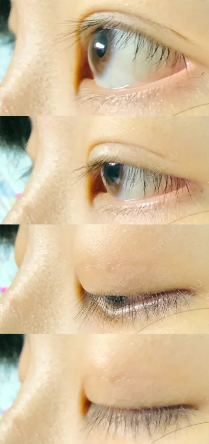 二重埋没 水の森美容クリニック 東京新宿院 DAY 10 メイン用