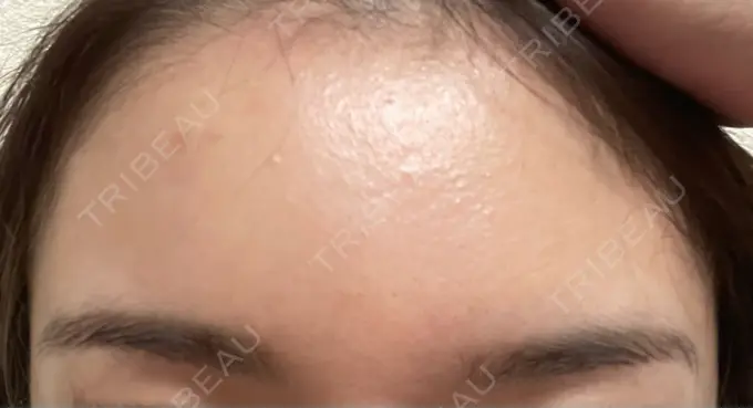 ボトックス（額） TCB東京中央美容外科 静岡院 DAY 24 メイン用