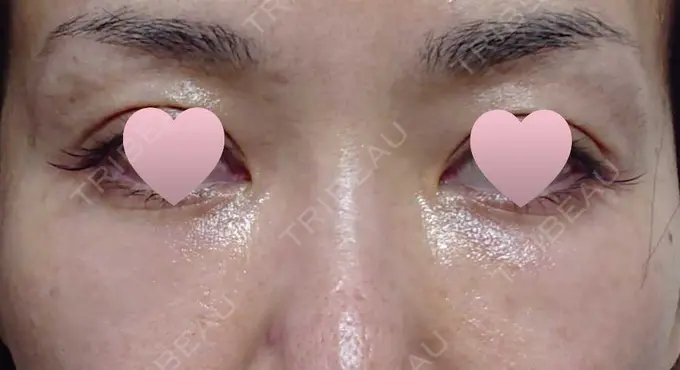 その他（目元） 赤坂プレミアクリニック DAY 2 メイン用