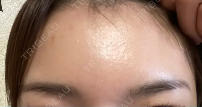 ボトックス（額） TCB東京中央美容外科 静岡院 DAY 25 メイン用