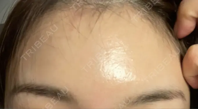 ボトックス（額） TCB東京中央美容外科 静岡院 DAY 26 メイン用