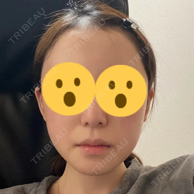 骨切り（あご） / 骨削り（エラ） リラ・クラニオフェイシャル・クリニック 大阪院 AFTER メイン用