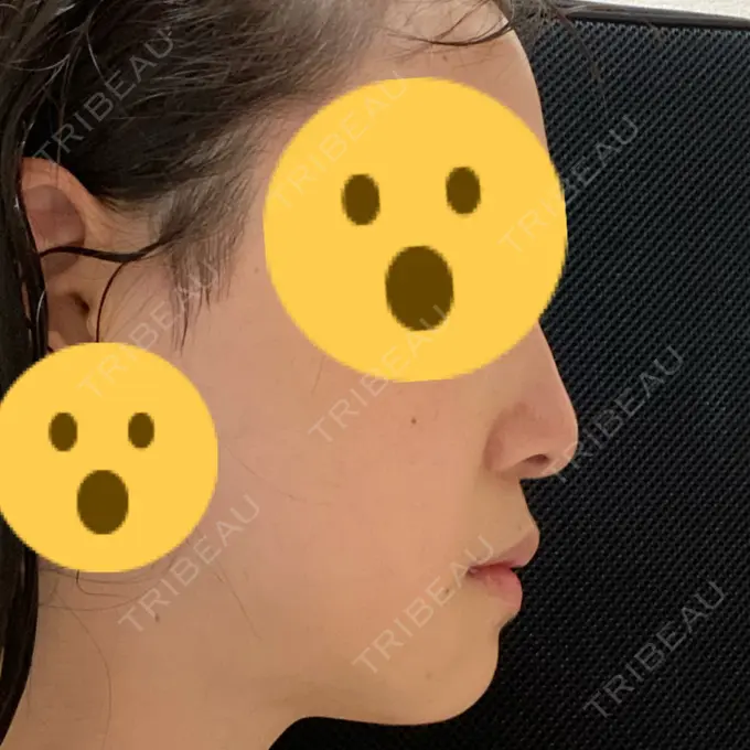 骨切り（あご） / 骨削り（エラ） リラ・クラニオフェイシャル・クリニック 大阪院 DAY 122 メイン用