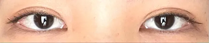 二重埋没 銀座S美容・形成外科クリニック DAY 12 メイン用