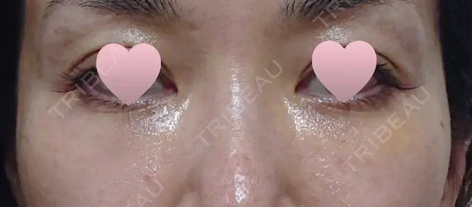 その他（目元） 赤坂プレミアクリニック DAY 4 メイン用