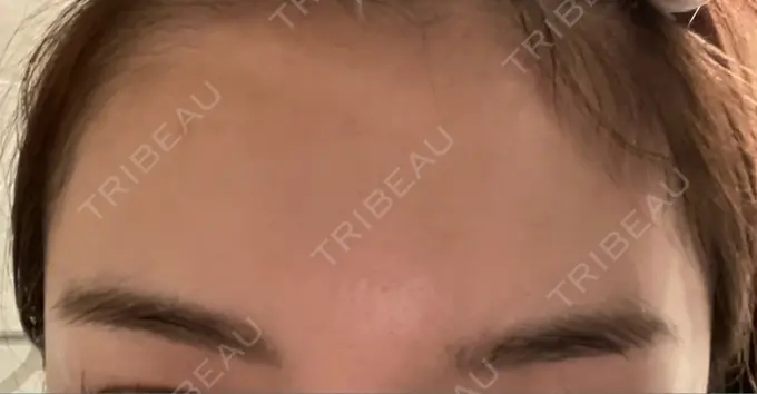 ボトックス（額） TCB東京中央美容外科 静岡院 AFTER メイン用