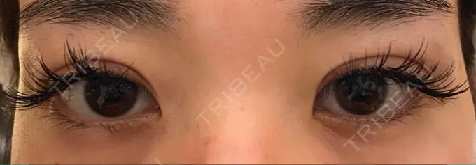 二重切開 / 上まぶたの脂肪取り 心斎橋コムロ美容外科クリニック DAY 32 メイン用