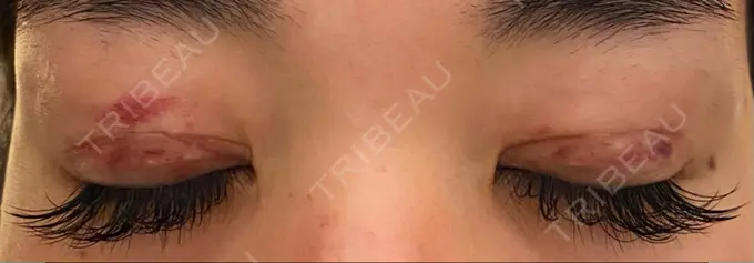 二重切開 / 上まぶたの脂肪取り 心斎橋コムロ美容外科クリニック DAY 32 メイン用