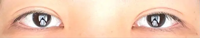 二重埋没 銀座S美容・形成外科クリニック DAY 13 メイン用