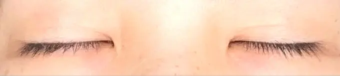 二重埋没 銀座S美容・形成外科クリニック DAY 13 メイン用