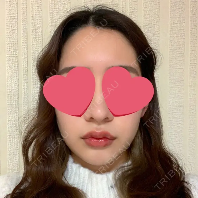 糸リフト / 脂肪吸引（顔） / メーラーファット除去 / ジョールファット除去 / ヒアルロン酸注入（頬） SEA CLINIC（シークリニック） DAY 85 メイン用