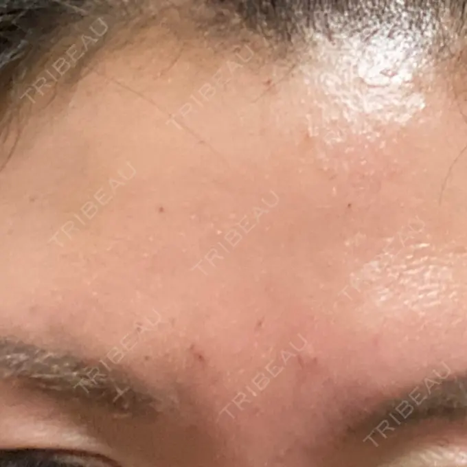 シワ取りボトックス TCB東京中央美容外科 宇都宮院 DAY 0 メイン用