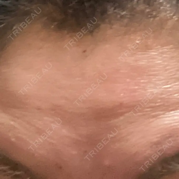 シワ取りボトックス TCB東京中央美容外科 宇都宮院 DAY 0 メイン用