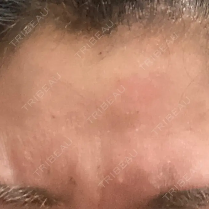 シワ取りボトックス TCB東京中央美容外科 宇都宮院 DAY 0 メイン用