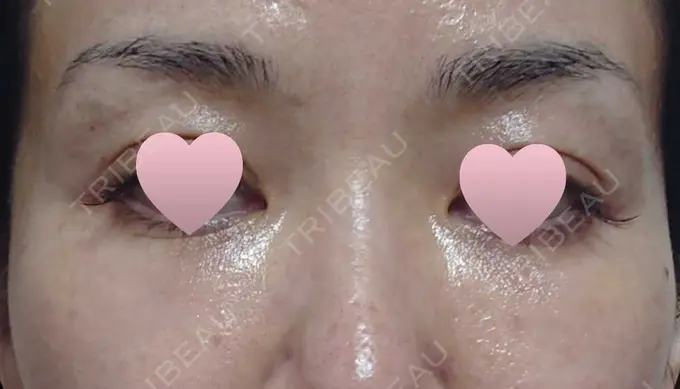 その他（目元） 赤坂プレミアクリニック AFTER メイン用