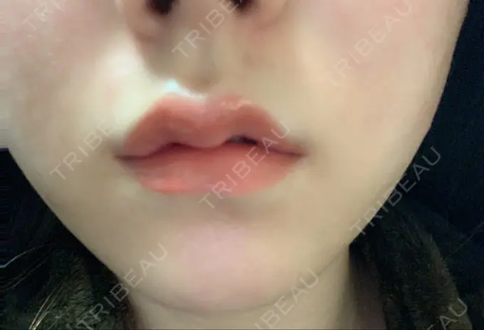 ヒアルロン酸注入（唇） YBC横浜美容外科 大宮院 DAY 0 メイン用