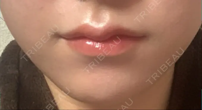 ヒアルロン酸注入（唇） YBC横浜美容外科 大宮院 DAY 4 メイン用