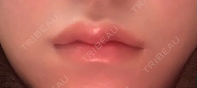 ヒアルロン酸注入（唇） YBC横浜美容外科 大宮院 DAY 5 メイン用