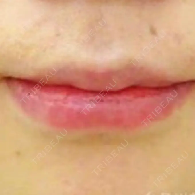 口唇縮小術 品川美容外科池袋院 DAY 9 メイン用