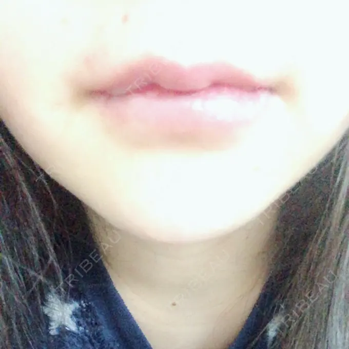 口唇縮小術 品川美容外科池袋院 DAY 10 メイン用