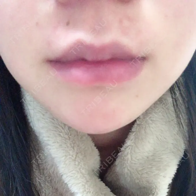 口唇縮小術 品川美容外科池袋院 DAY 19 メイン用