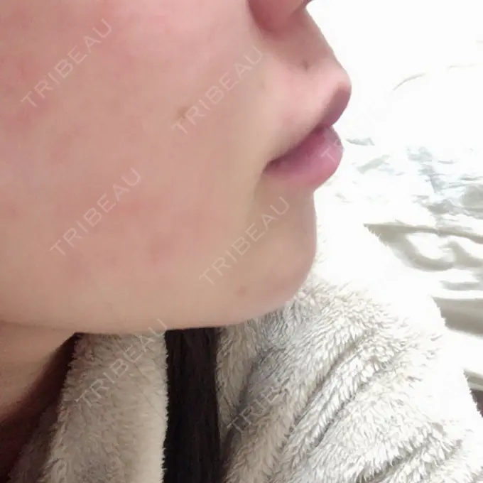 口唇縮小術 品川美容外科池袋院 DAY 19 メイン用