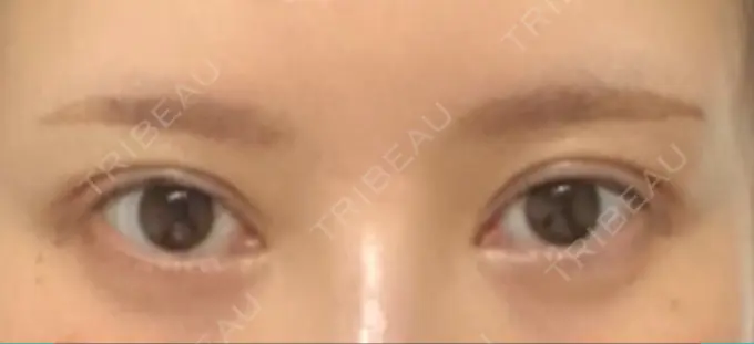 二重埋没 / 目頭切開 湘南メディカル記念病院（両国） AFTER メイン用