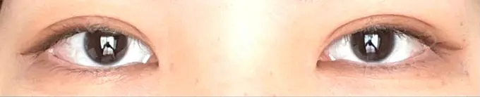 二重埋没 銀座S美容・形成外科クリニック DAY 14 メイン用