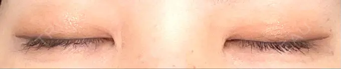 二重埋没 銀座S美容・形成外科クリニック DAY 14 メイン用