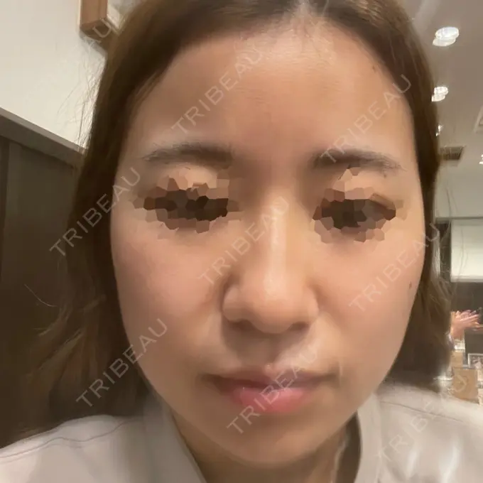 ハイフ（顔） STARS CLINIC DAY 0 メイン用