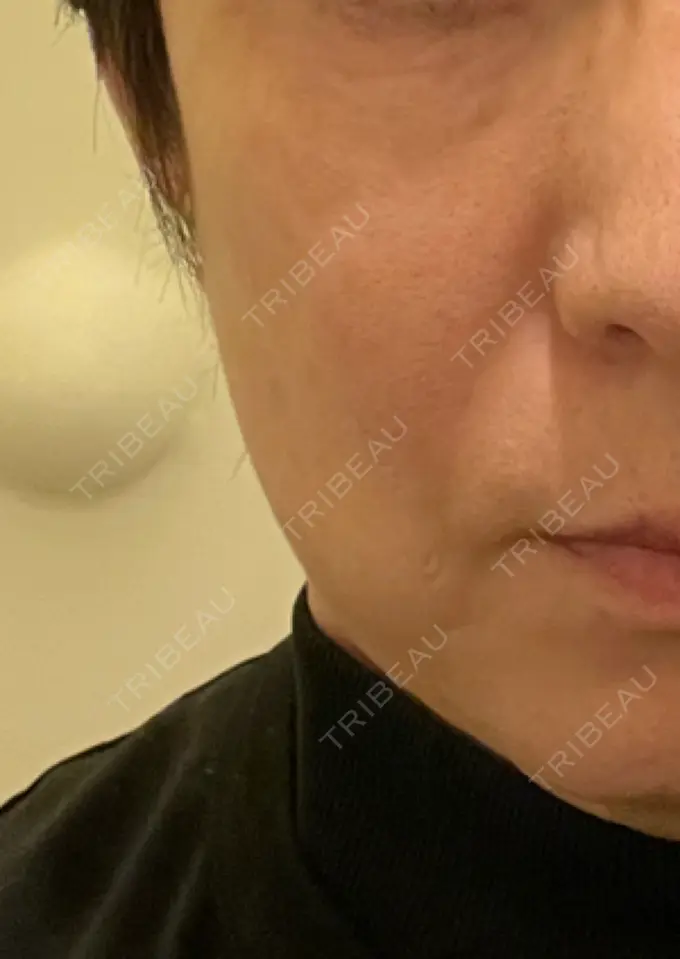 ハイフ（顔） みずほクリニック AFTER メイン用