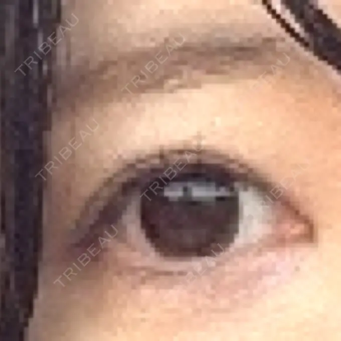 眉下切開 湘南美容クリニック 秋葉原院 DAY 351 メイン用