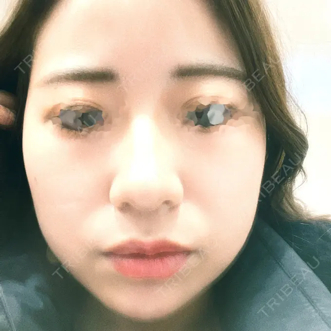 ハイフ（顔） STARS CLINIC DAY 1 メイン用