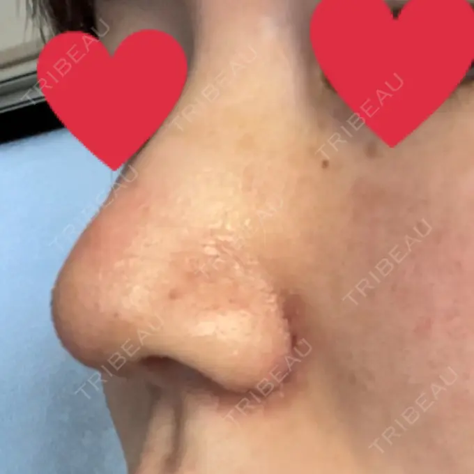 鼻尖形成（切開） / 小鼻縮小（切開） / 軟骨移植 麹町皮ふ科・形成外科クリニック DAY 10 メイン用