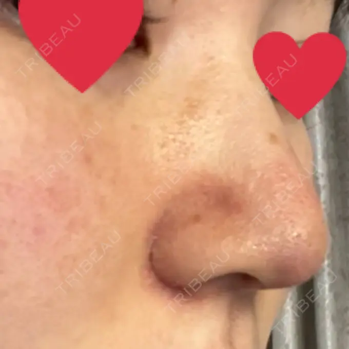 鼻尖形成（切開） / 小鼻縮小（切開） / 軟骨移植 麹町皮ふ科・形成外科クリニック DAY 10 メイン用