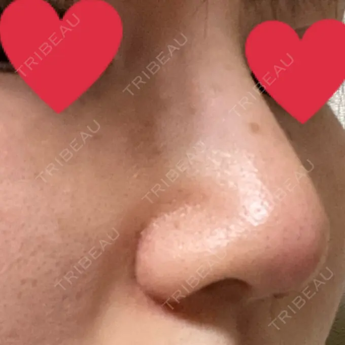 鼻尖形成（切開） / 小鼻縮小（切開） / 軟骨移植 麹町皮ふ科・形成外科クリニック DAY 15 メイン用