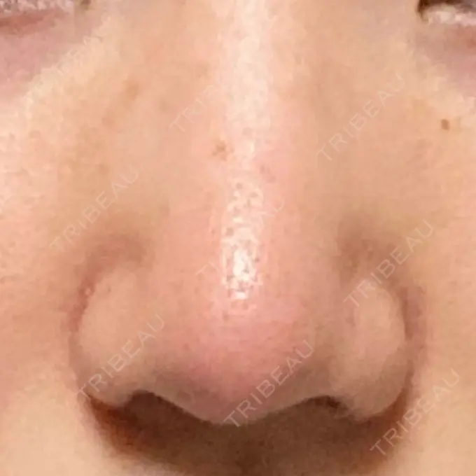 鼻尖形成（切開） / 小鼻縮小（切開） / 軟骨移植 麹町皮ふ科・形成外科クリニック DAY 15 メイン用